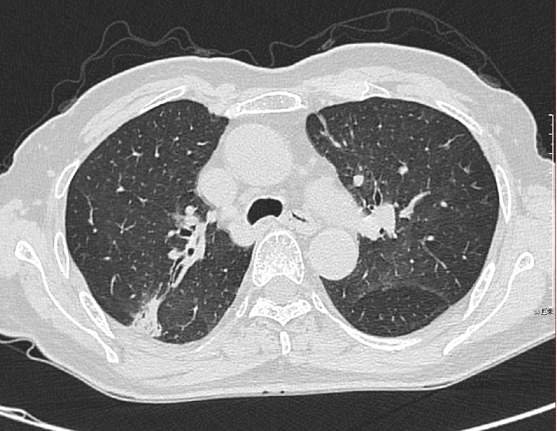 脱敏胸部 CT 轴位示例
