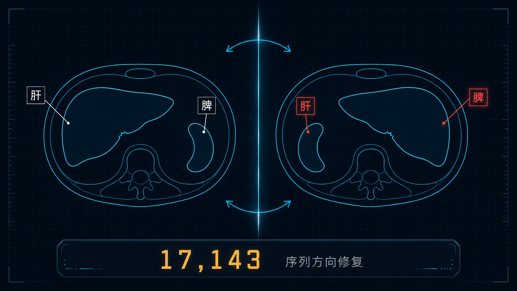 CT 镜像参考系导致器官标签互换示意